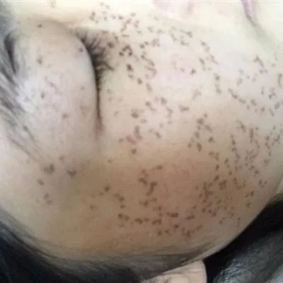雀斑可以去除吗