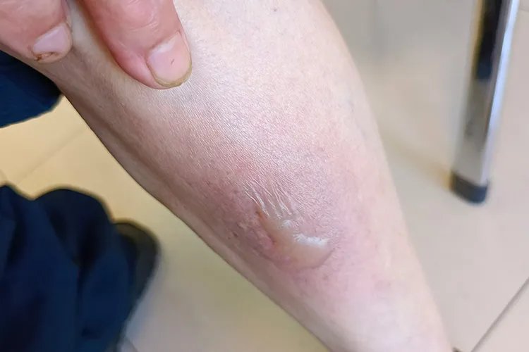 过敏性皮炎图片和症状