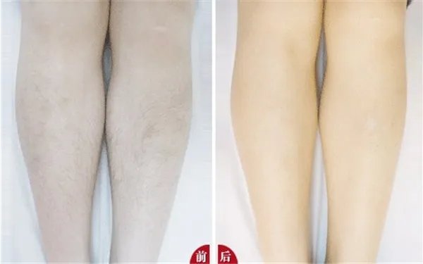 e光脱毛有副作用吗