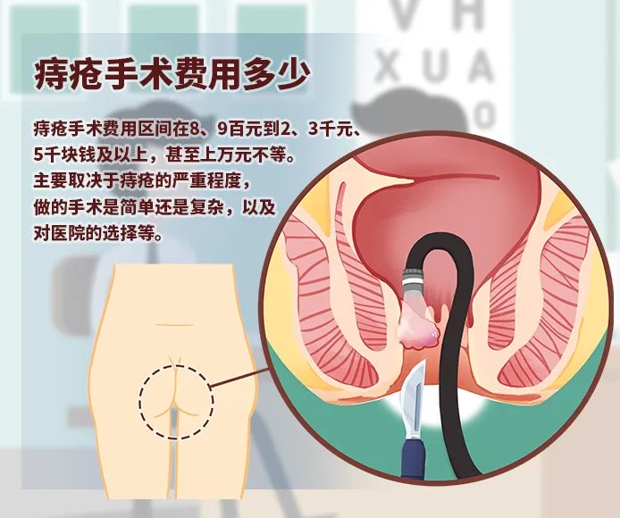 痔疮手术费用多少