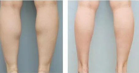 怎么才可以瘦小腿