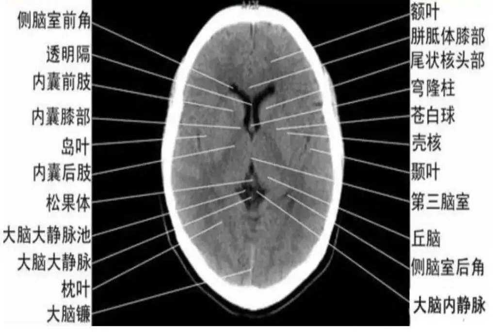 基底节层面ct解剖图
