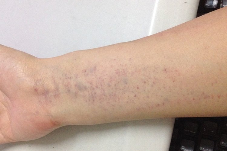 单纯性紫癜初期的图片