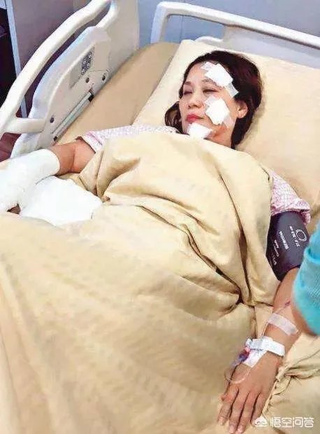 杨盼盼片场烧伤严重吗？你怎么看？