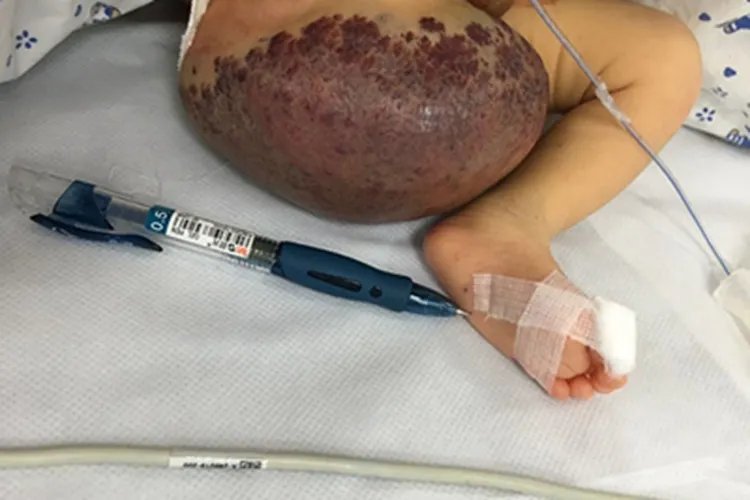 血管瘤长瘤图片