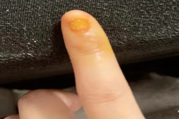 拔指甲后10天能恢复图片