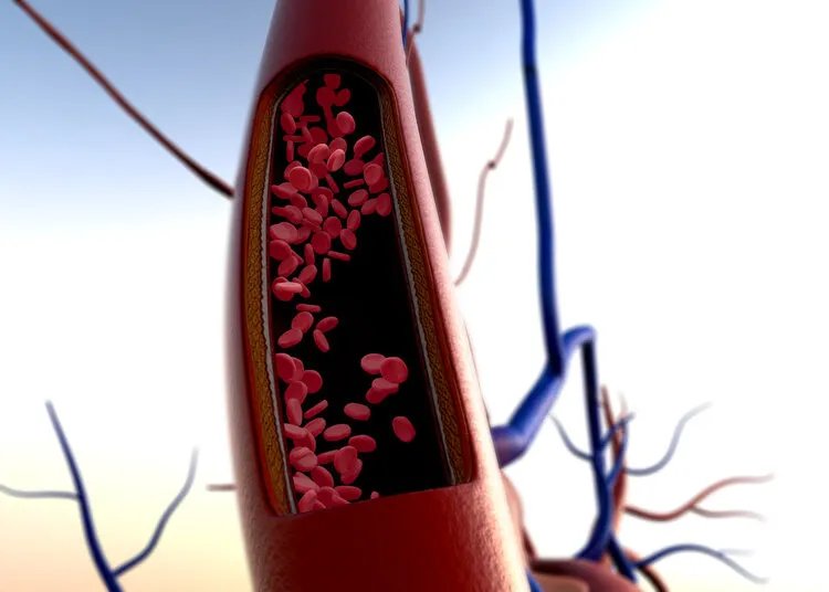 心脏支架降价后，医生开始滥用药物球囊？球囊会替代支架吗？