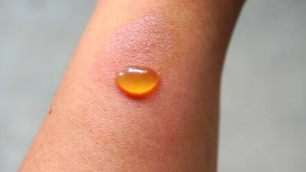 宝宝烫伤怎么办