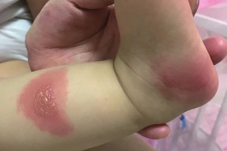 脚上突然红了一块图片