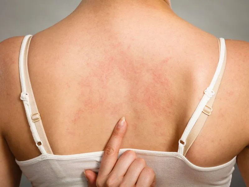 人工性荨麻疹的症状