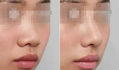 假体隆鼻要多少钱