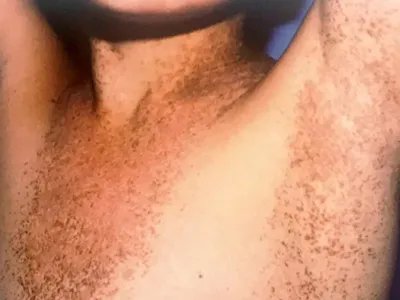 皮肤垢着病症状图片