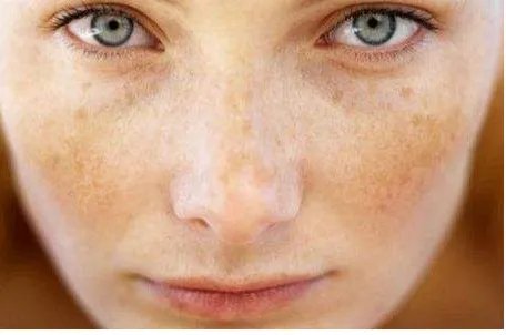 光子嫩肤祛斑效果如何表现