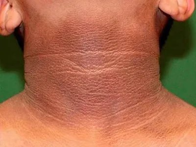 皮肤垢着病症状图片