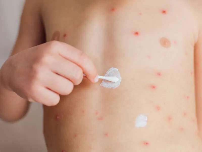 全身起红疙瘩很痒怎么办