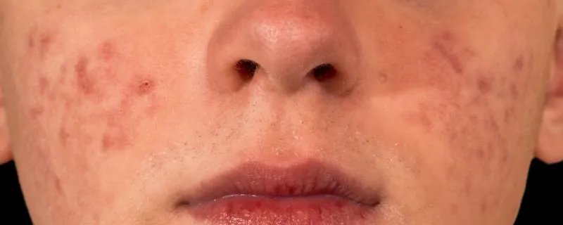 粉刺和痘痘的区别是什么 怎么区分痘痘和粉刺