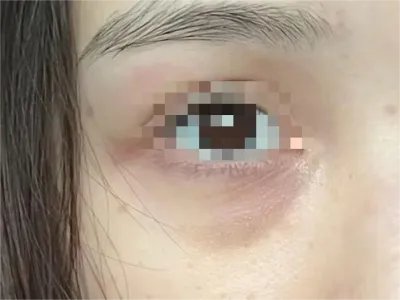 眶周黑变皮肤颜色加深图片