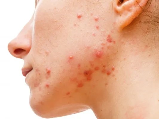 面部痤疮的治疗方法