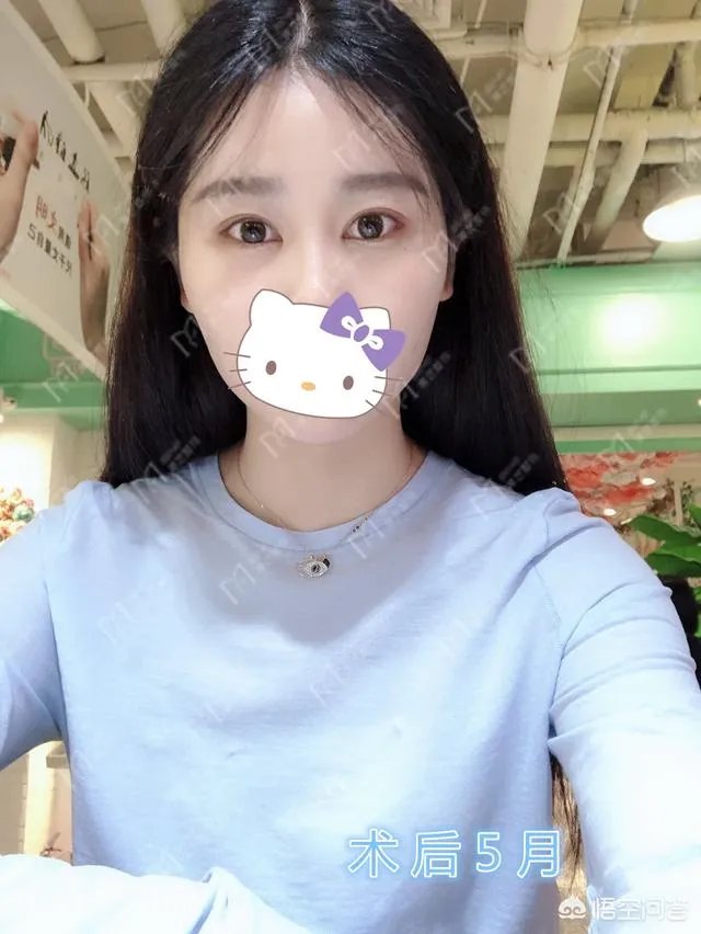 上睑下垂矫正术一定要做双眼皮吗