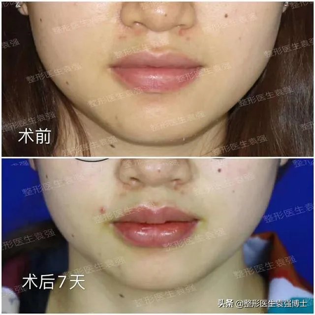 鼻部整形有哪些?