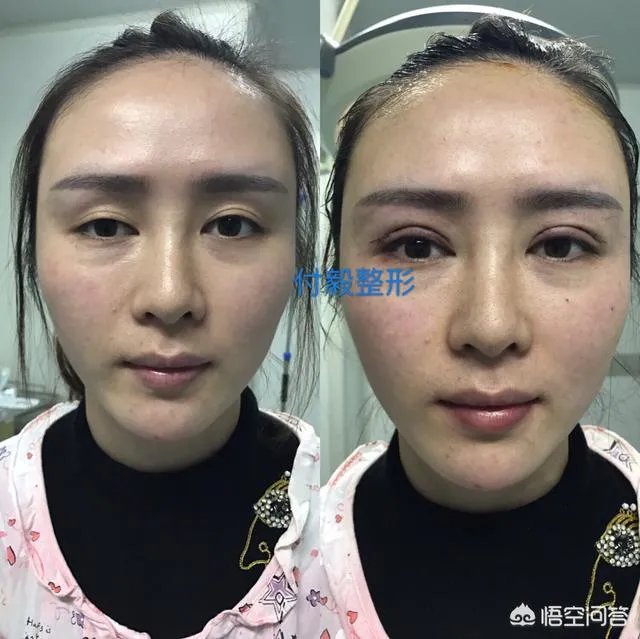 上睑下垂矫正术一定要做双眼皮吗