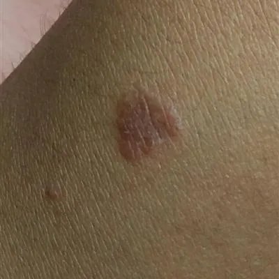 牛皮癣治疗的方法有哪些