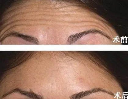 抬头纹可以去掉吗