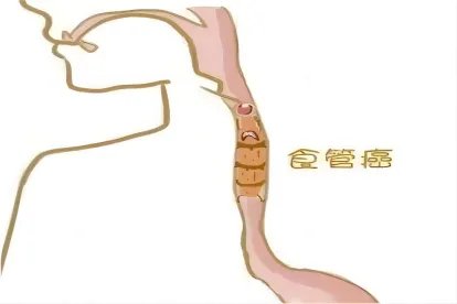 食道癌位置图片大全