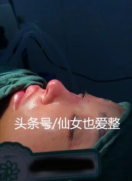 有哪些整容失败的女明星？