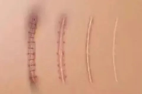 缝针伤口愈合过程图解