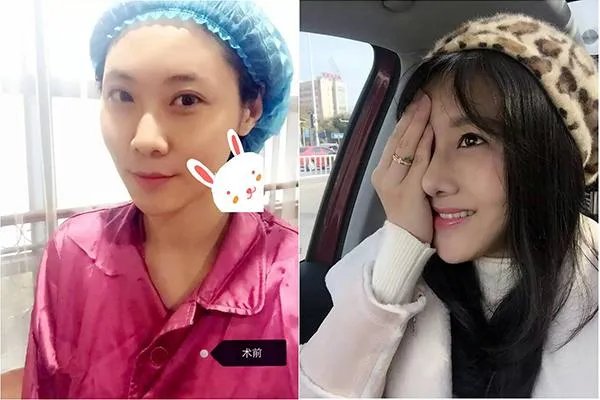 鼻部整形有哪些？