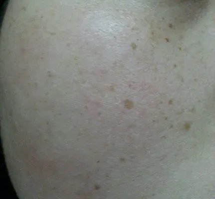 眼角有黄褐斑是什么原因?