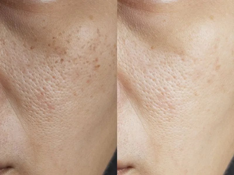 脸上长了色斑怎么办