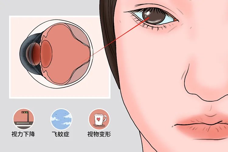 视网膜剥离症发生于什么部位