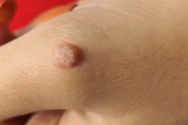 皮肤病真实照片大全