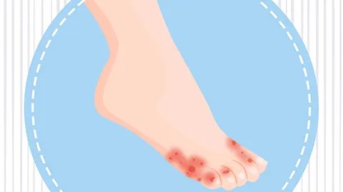 脚气产生的原因是什么