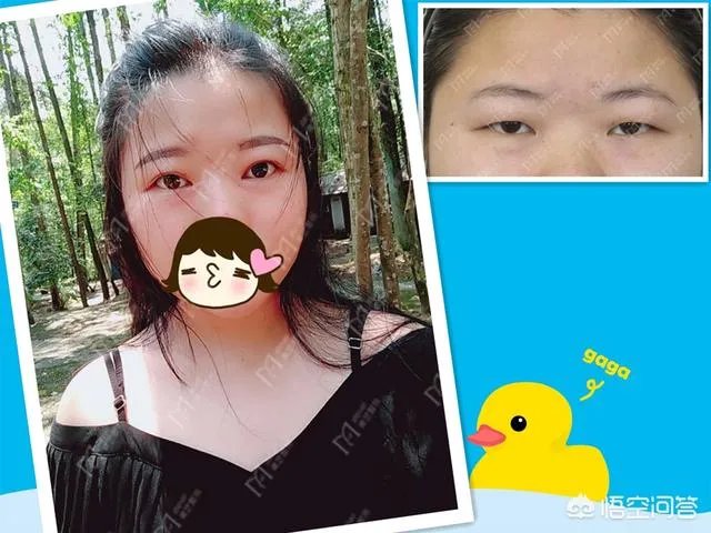 上睑下垂矫正术一定要做双眼皮吗