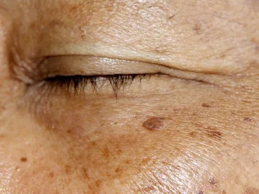 如何治疗面部黄褐斑