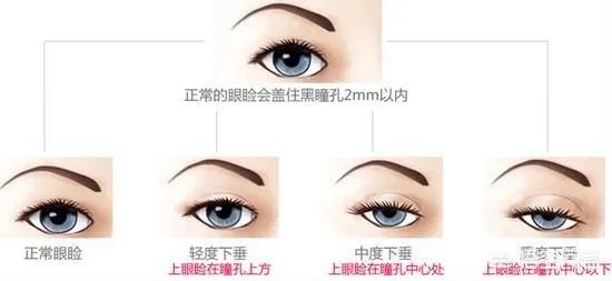 上睑下垂矫正术一定要做双眼皮吗