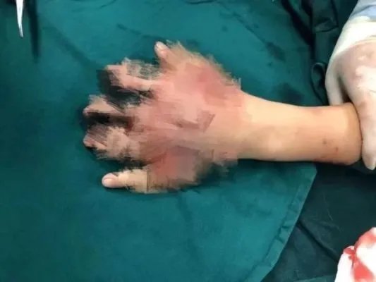 12岁男孩初一玩鞭炮左手5指全断,事情的起因是什么?