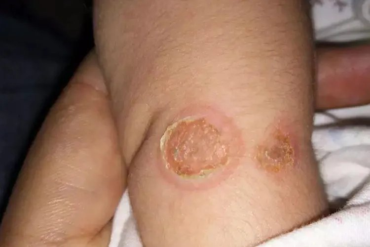 皮肤病真实照片大全