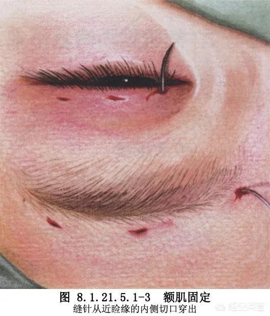 上睑下垂矫正术一定要做双眼皮吗