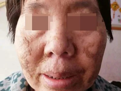 皮肤垢着病症状图片