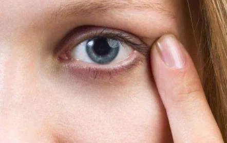 去眼袋黑眼圈怎么护理