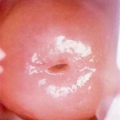 治疗宫颈糜烂的药物