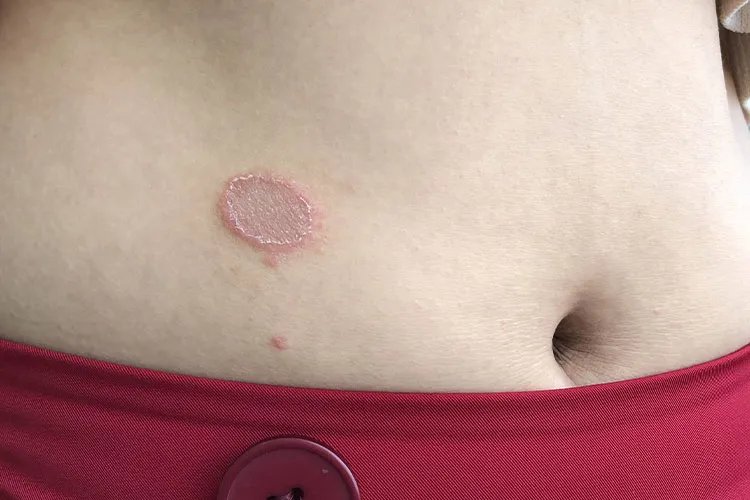 皮肤病真实照片大全