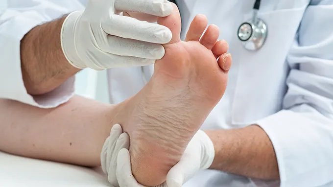 治疗鸡眼的药有哪些