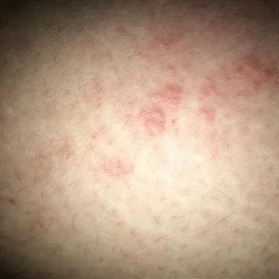 艾叶怎么治疗湿疹