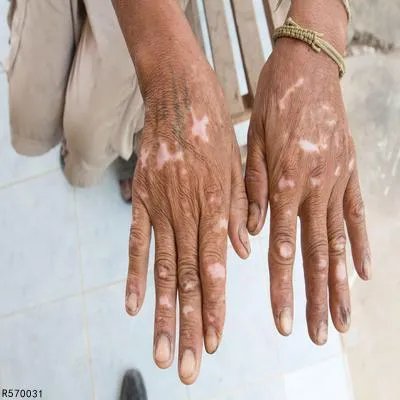 白癜风病应该怎么治疗好