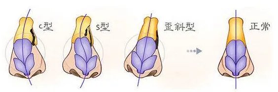 做鼻骨矫正大概需要多少钱？